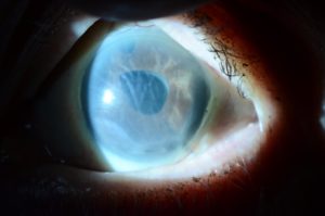 eye clinic abuja corneal-swelling