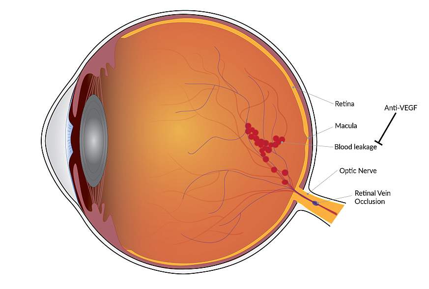 best eye clinic in abuja