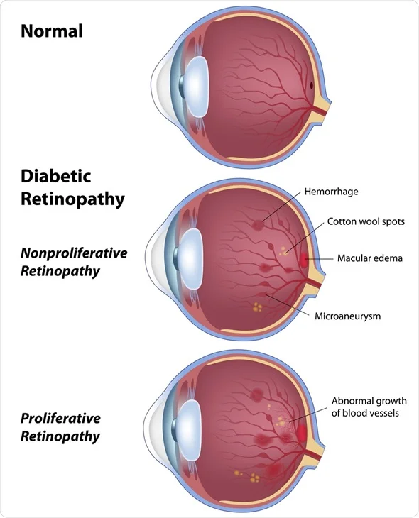 Diabetic retinopathy is a serious eye condition that affects individuals with diabetes. It occurs when high blood sugar levels damage the blood vessels in the retina, leading to vision problems and potentially blindness.