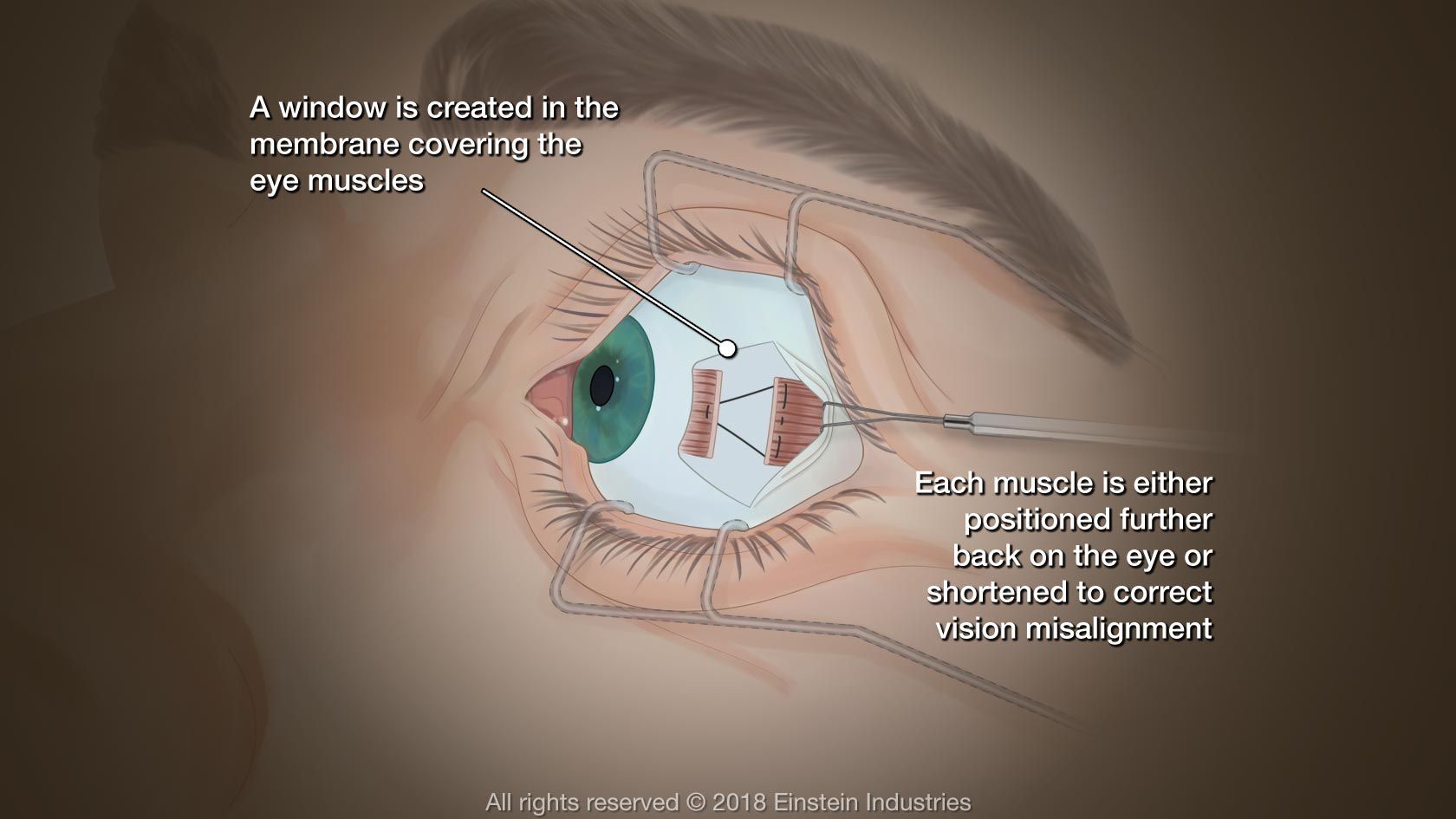 An illustration of an eye that has been surgically treated at an Eye clinic in Abuja.