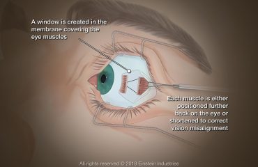 An illustration of an eye that has been surgically treated at an Eye clinic in Abuja.